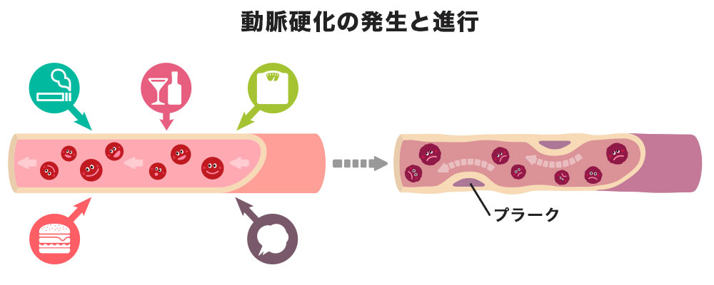図表:動脈硬化