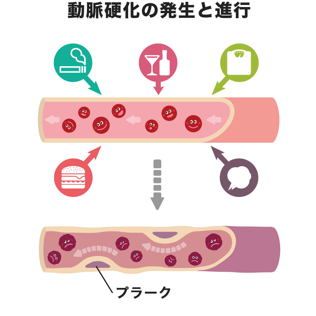 図表:動脈硬化